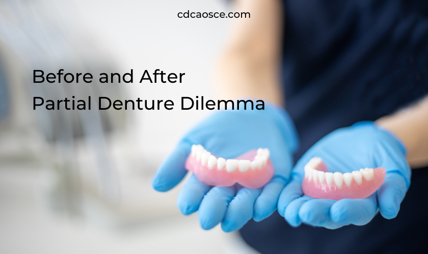 before and after partial denture