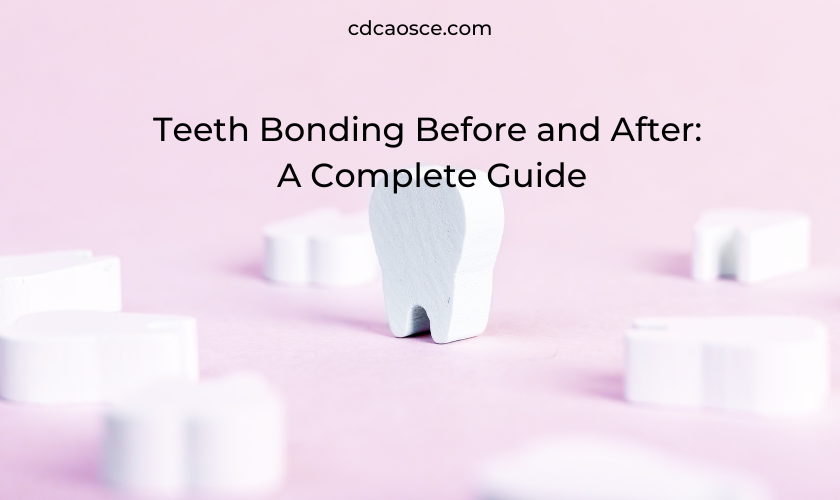 teeth bonding before and after